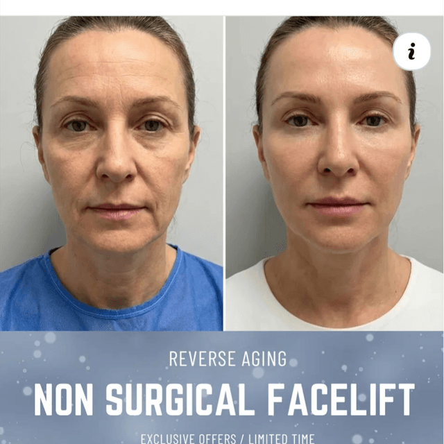 Cryo Facial (20 sessions) at The Sculpted Body Contour Spa in Washington, MO